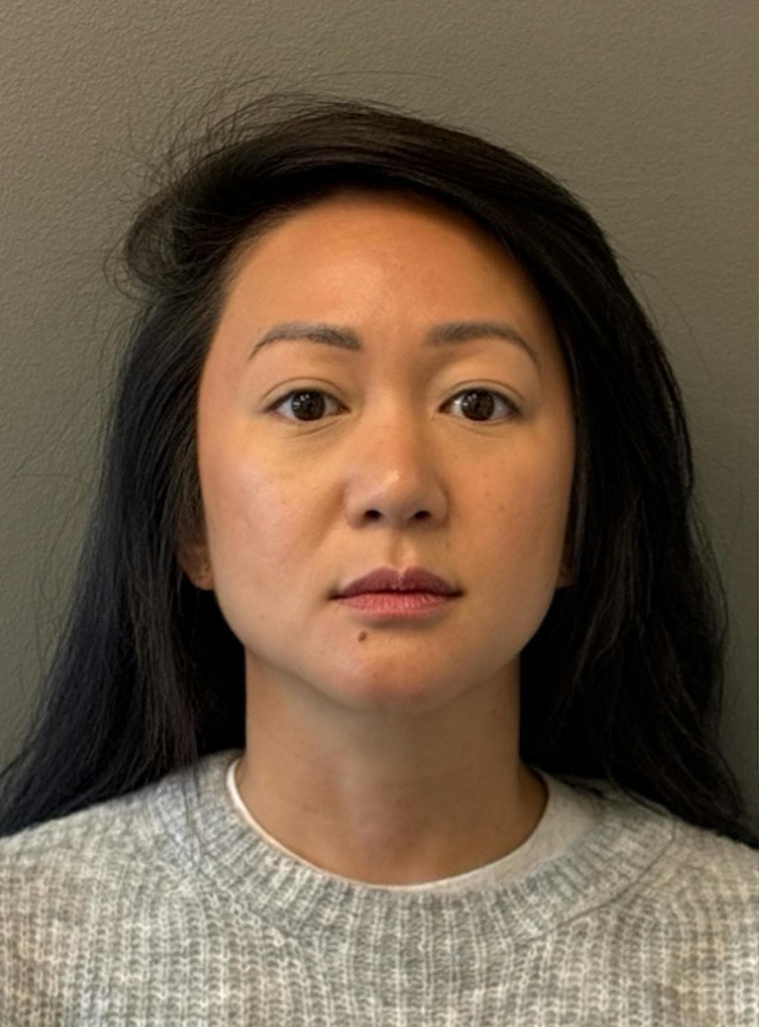 Blepharoplasty — Before